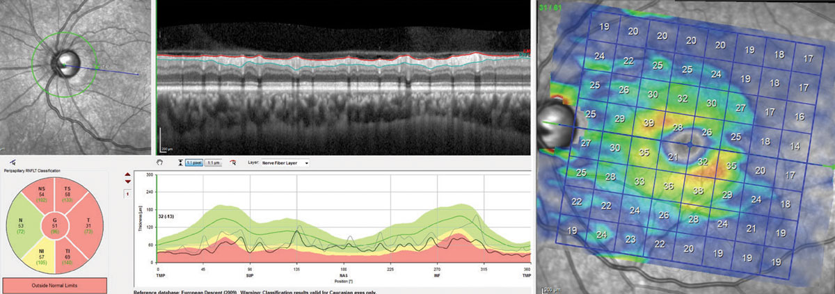 Cp-RNFL, at left, and isolated GCL, at right, shows RNFL tissue at “floor” (average RNFL of 51µm). The segmentation scan shows that the majority of the tissue thickness comes from the blood vessels, not neural tissue. Although a double arcuate loss of tissue exists on the GCL scan, there is sufficient tissue to track structural progression, whereas the RNFL scan is no longer useable.