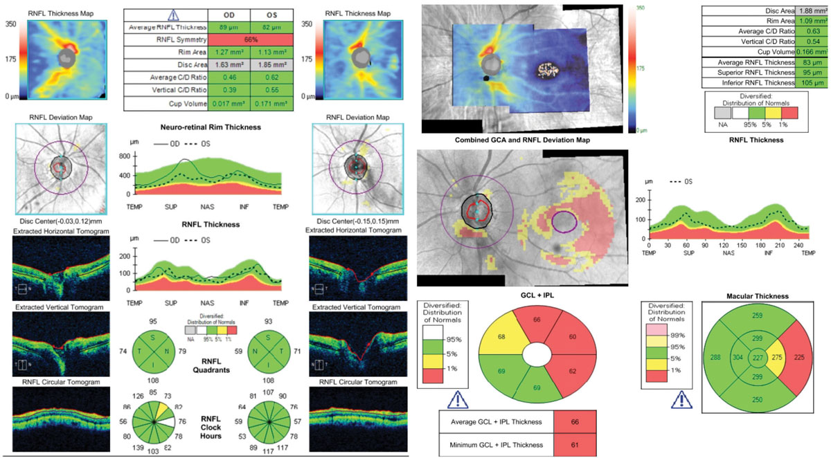 This 62-year-old patient shows optic discs that appear glaucomatous OS>>OD funduscopically. Cursory analysis of the RNFL printout (at left) alone might give the false sense that there are no pathological changes compared with the reference database. The additional analysis of all tissues affected by glaucoma, at right, confirms the diagnosis of early glaucoma. This highlights the necessity of using all of the information these machines provide.