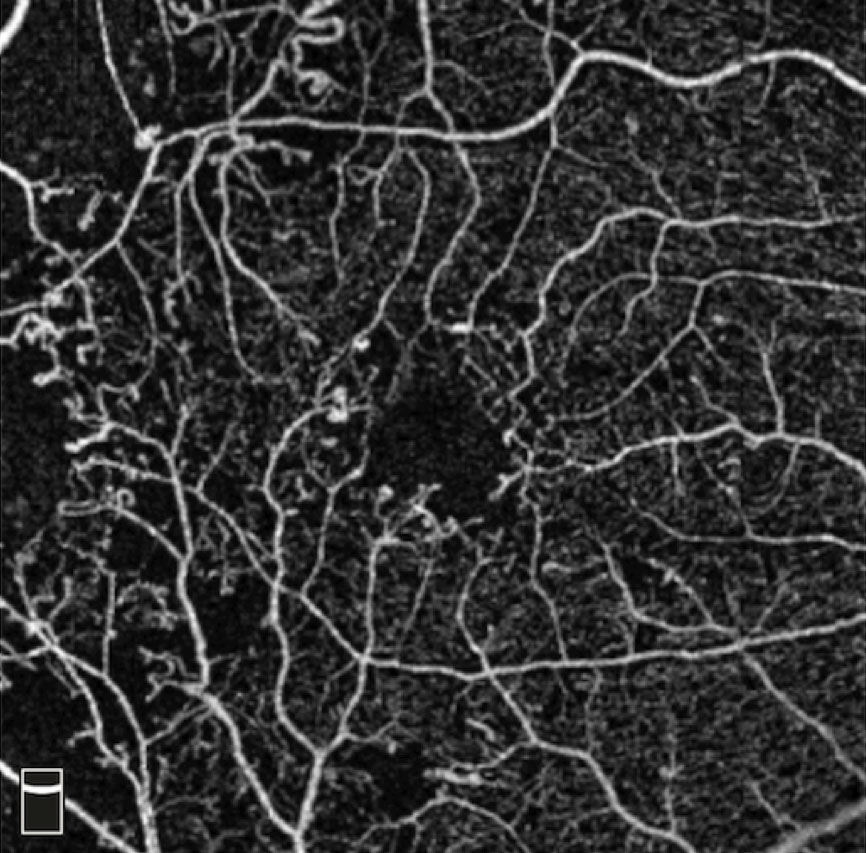 Fig. 2. This OCT-A shows a patient with microaneurysms and capillary dropout.