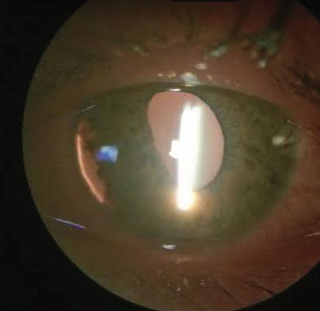 Fig. 1. This photo shows our patient’s iridodialysis with accompanying inferior nasal transillumination defect.