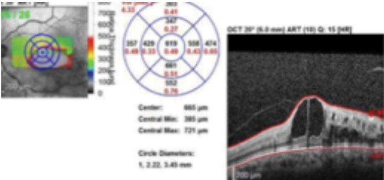 Fig. 2. SD-OCT imaging confirmed macular edema in the left eye. 