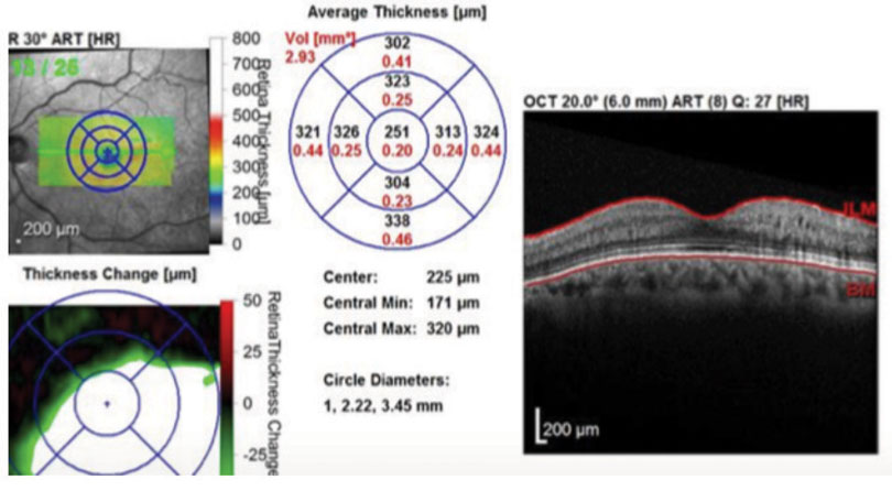 Fig. 3. One month after implanting Ozurdex, the patient’s edema was once again under control with a normal macular contour.