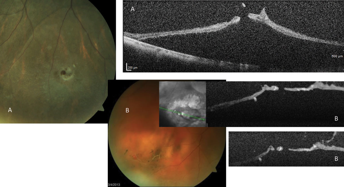 Fig. 10. Patient (A)’s images reveal an operculated hole resulting in an acute RRD. Patient (B), who had a pre-existing lattice, displays an operculated hole during PVD resulting in acute RRD.