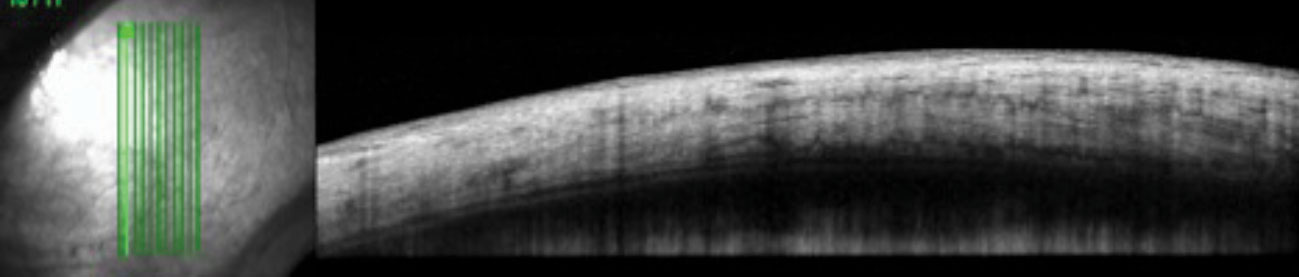 The control image of the same quadrant in the patient’s fellow eye shows homogenous reflectivity throughout the layers. 