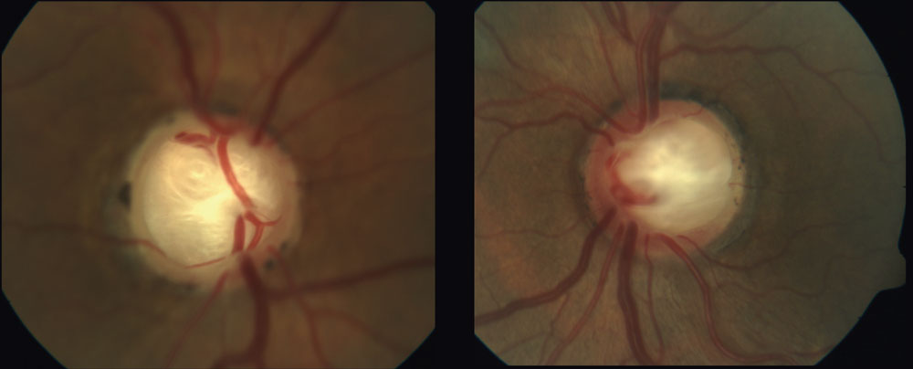 Deep laminar cupping can be seen in this 70-year-old patient whose in-office IOPs never exceeded 19mm Hg. Lower CSFP with subsequent alteration to the TLPD may have resulted in the substantial excavation in this NTG case.