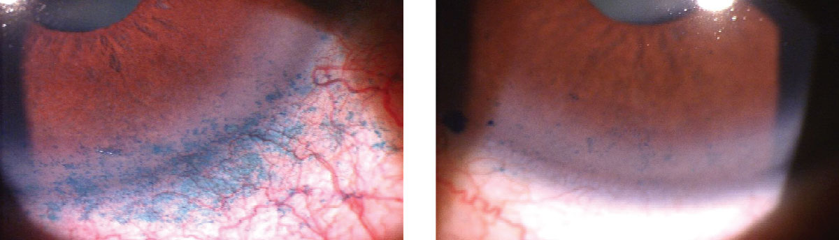 Lissamine green staining of the conjunctiva and cornea identifies BAK toxicity from a prostaglandin. This patient was switched to a preservative-free prostaglandin analog. His signs and symptoms of dry eye improved over the next three months.