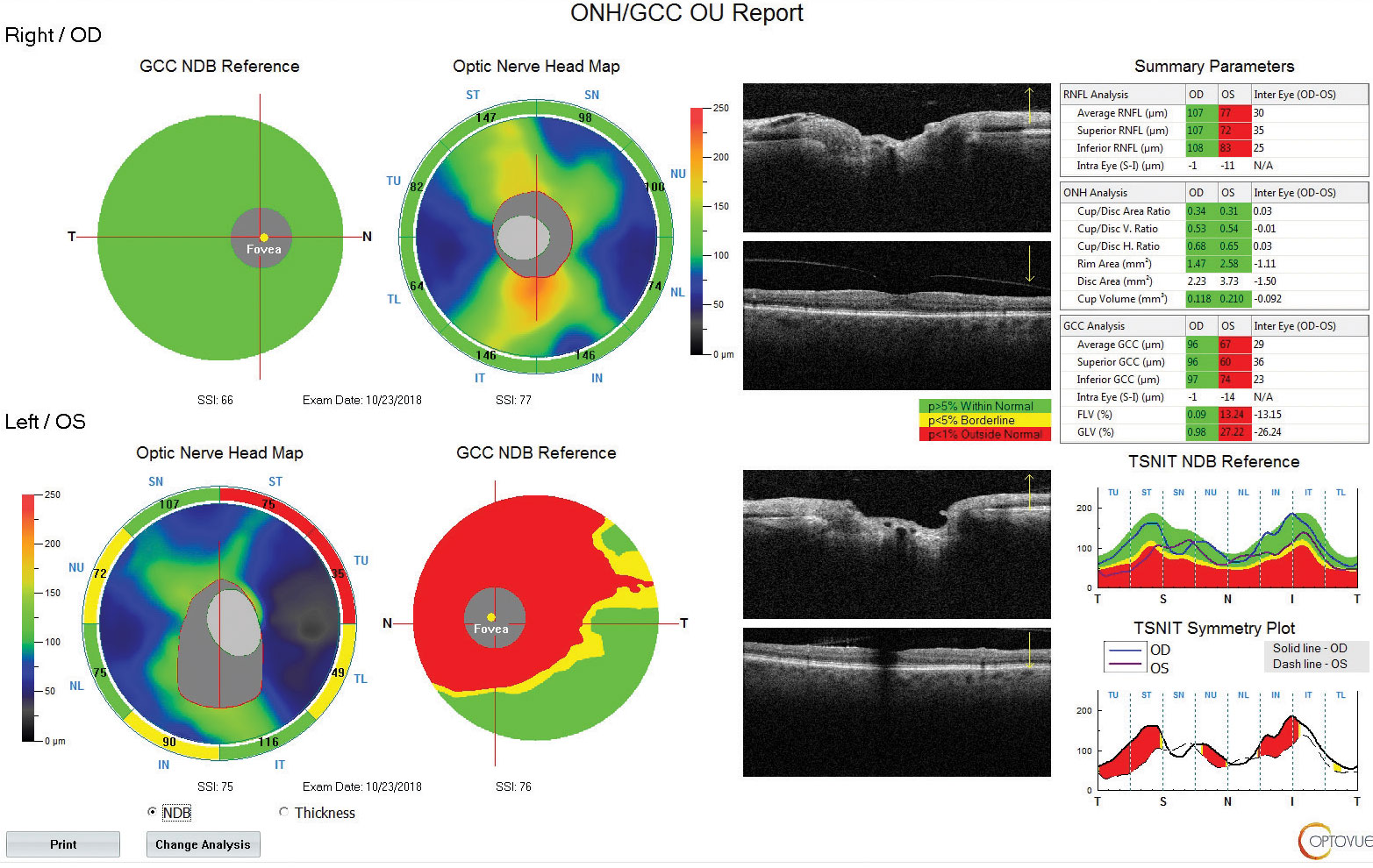 Fig. 3. Using OCT technology, we can see the patient also has a reduced paramacular ganglion cell complex with supratemporal atrophy of the RNFL.