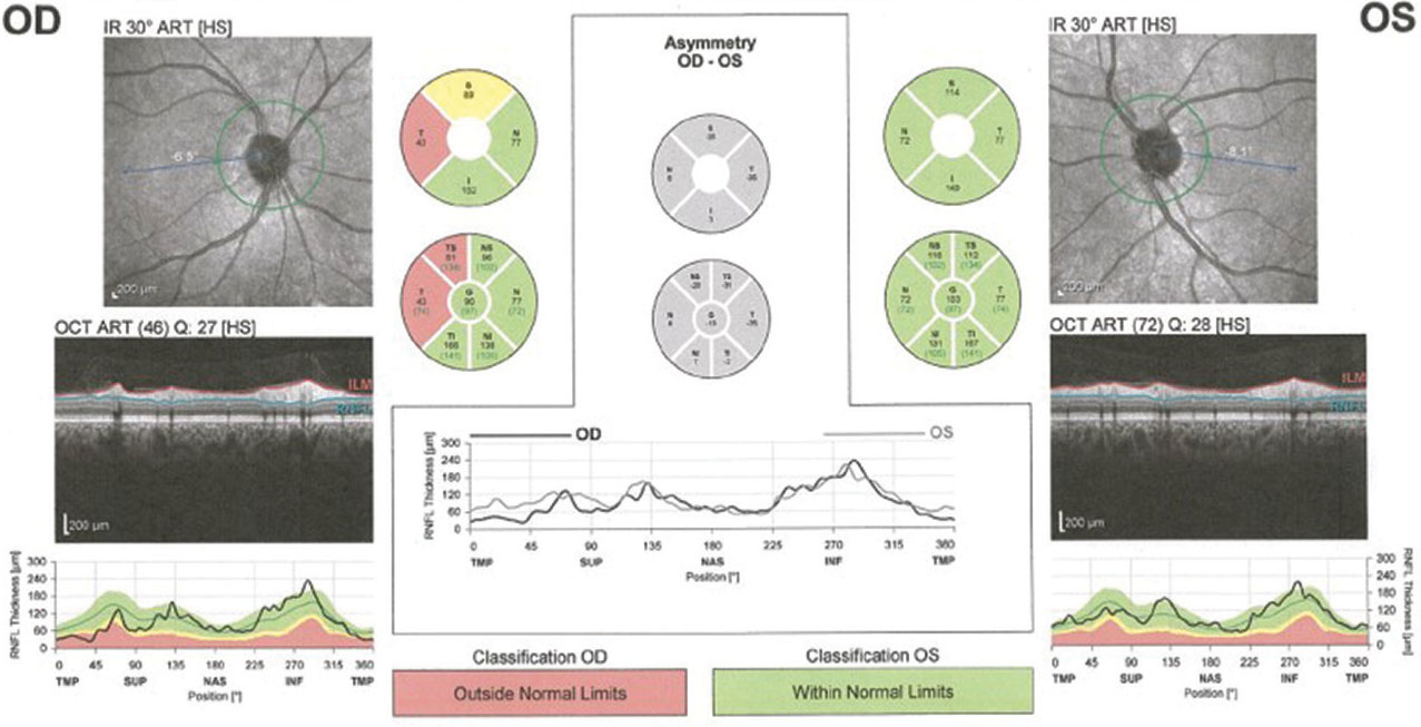 Fig. 5. This OCT reading of the same patient from page 58 confirms her RNFL damage.