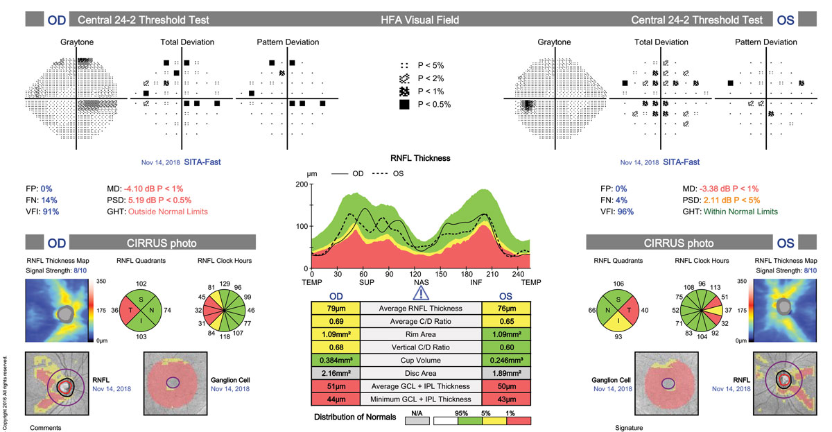 Reduced NFL and GCC consistent with bitemporal pallor and VF loss can point to MS as the possible culprit.