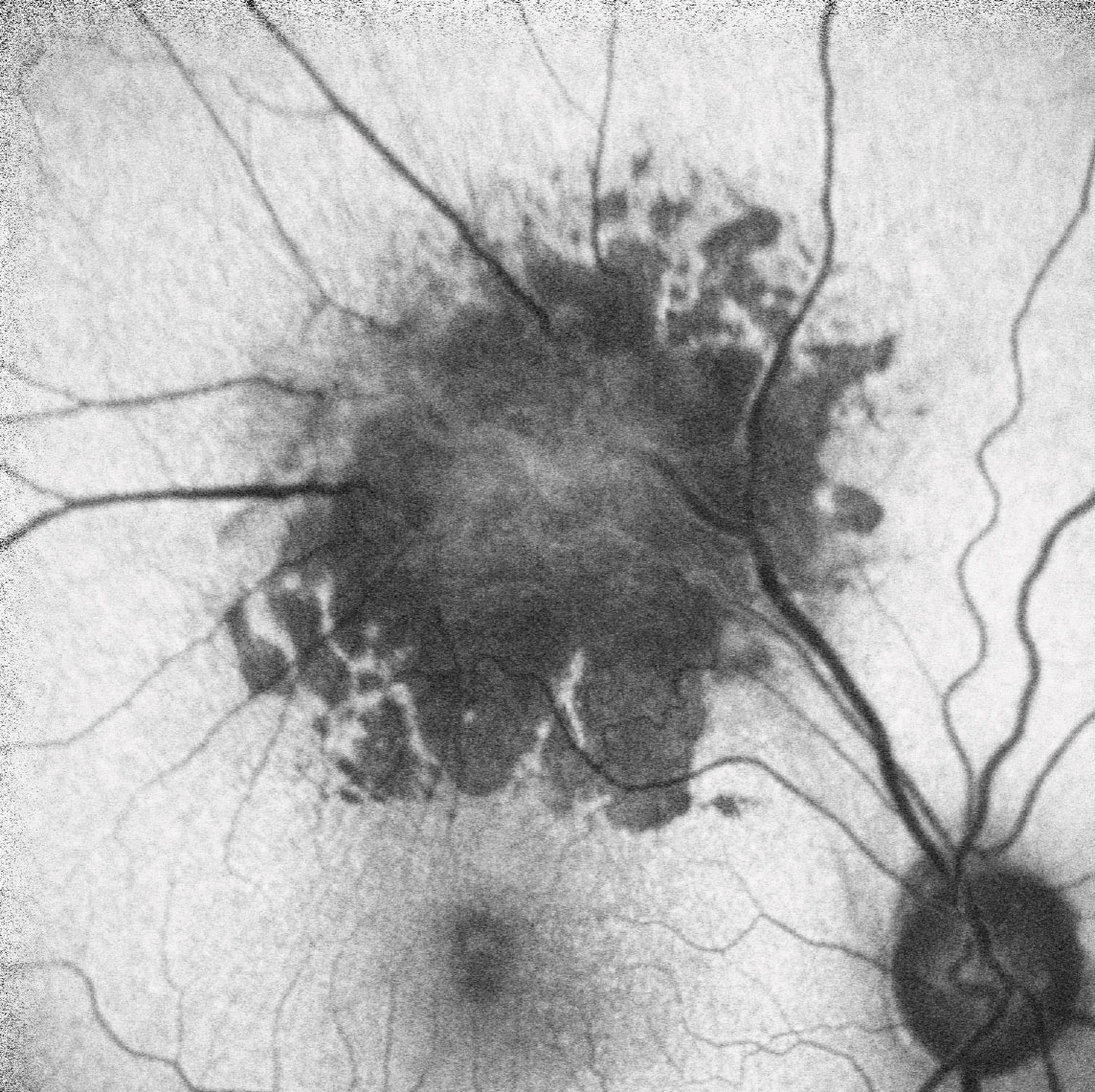 Fig. 2. A close up view of the right eye of our patient. 