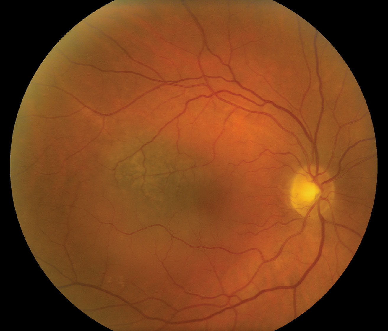 This fundus photo shows a small, cream-colored choroidal melanoma within the posterior pole without overlying retinal detachment.