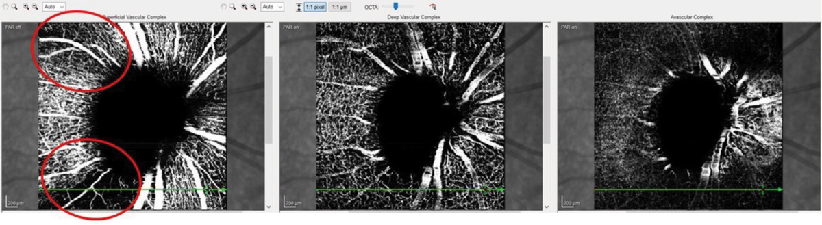 Fig. 1. These OCT-A images show a patient with advanced glaucoma. Note the areas of decreased vascular density (circled in red). They coincide nicely with the superior temporal and inferior temporal RNFL sectors that are preferentially damaged in glaucoma.