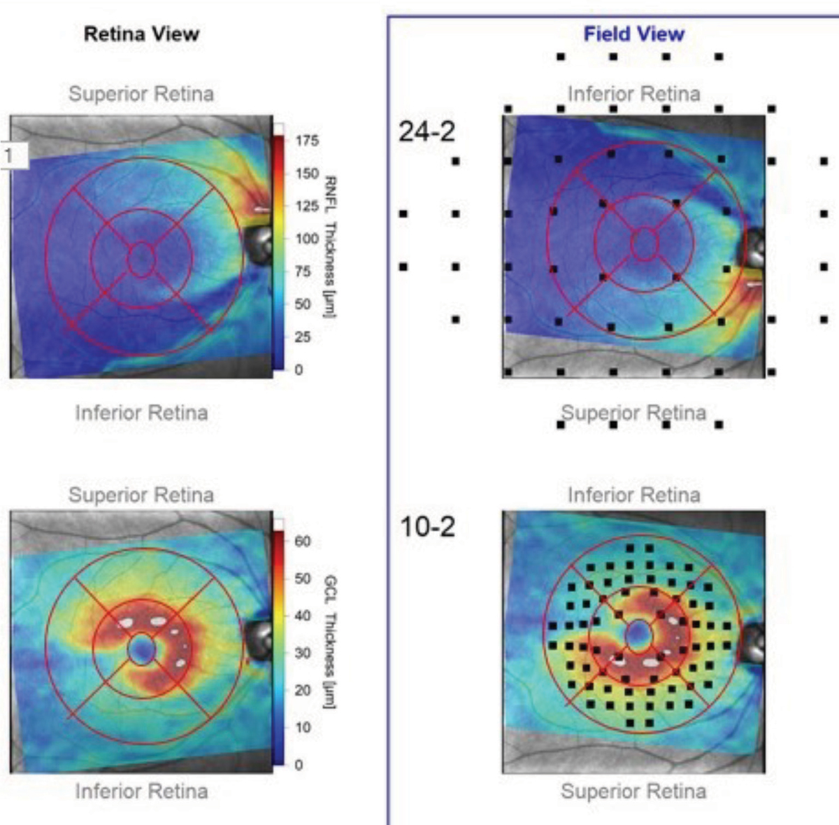 Fig. 3. These RNFL diameter circle scans show the patient’s right eye. Note the stability of the innermost RNFL circle scan of the most recent visit compared with the baseline visit obtained 18 months earlier. Where there is a difference between the scans, the thickness differences overlay major perioptic retinal blood vessels.