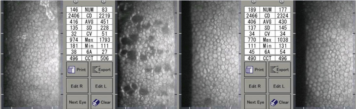 A patient with unilateral iritis OS. Note the resolution of the pseudoguttata and improvement in indices. 