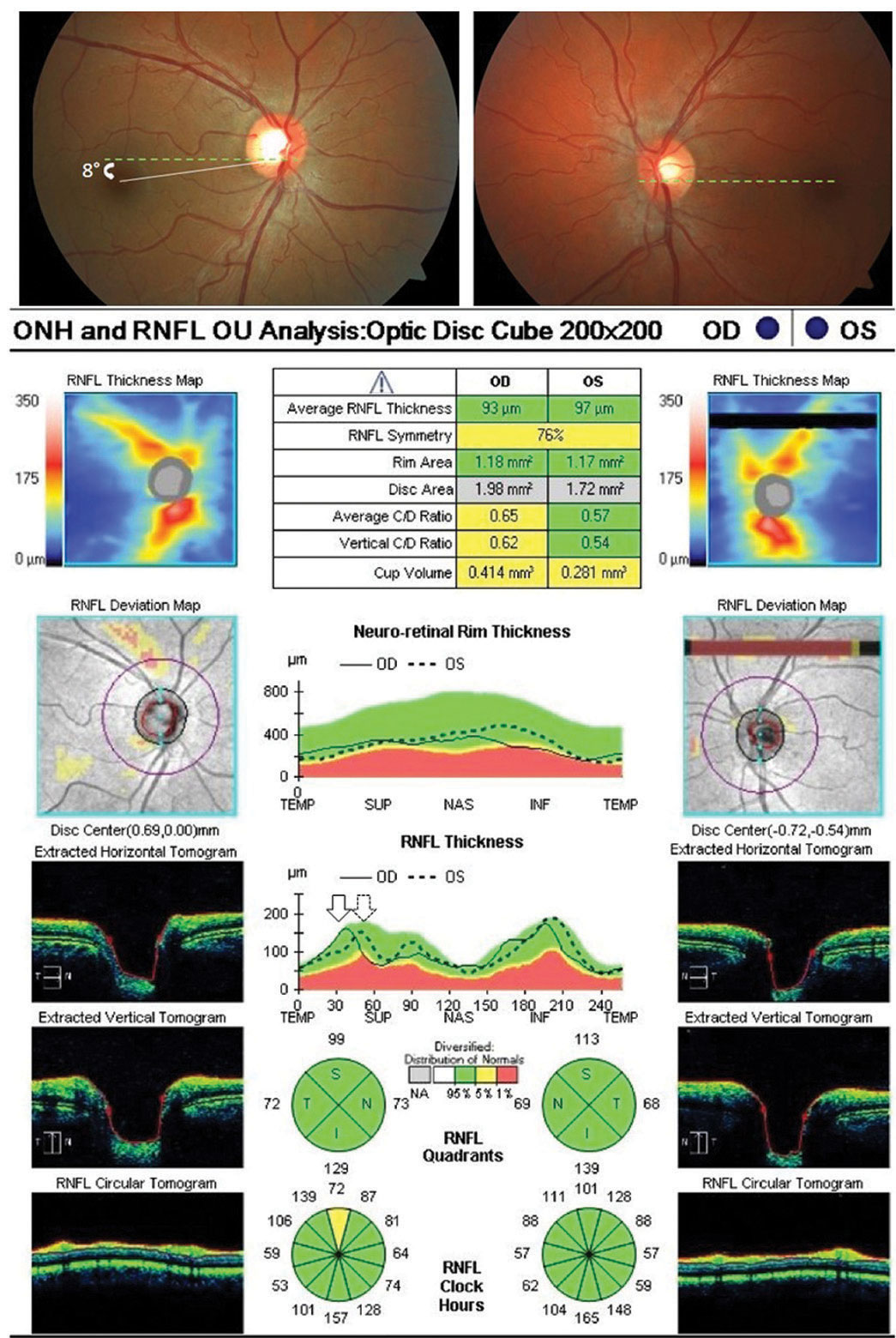 Fig. 1. Optic nerve OCT shows objective excyclotorsion OD (leftward shifting of the right eye TISNT graph in relation to the left) in a patient complaining of intermittent vertical diplopia with a low magnitude right hyperphoria. No subjective torsion was noted via double Maddox rod testing, suggestive of a congenital superior oblique palsy.