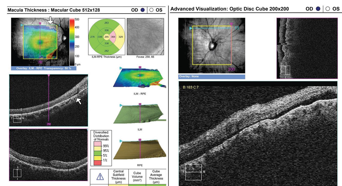 Fig. 6. This 35-year-old with a history of blunt trauma OD and 20/30+ acuity was referred for evaluation of IOP elevation. OCT reveals a very shallow RRD involving the superior aspect of the optic nerve head cube (right) and superior macula (left, arrows). Referral was emergent. 