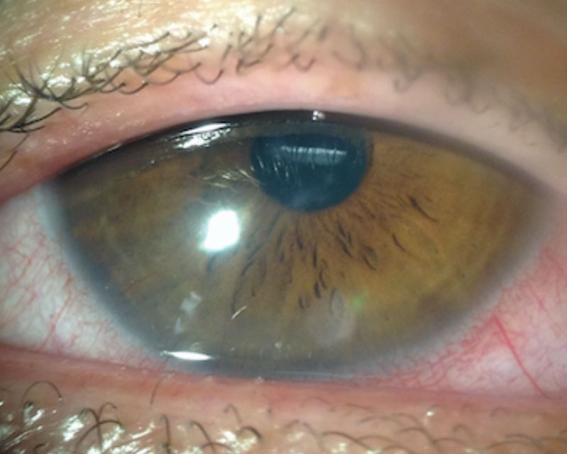 This patient’s anterior segment evaluation shows a case of CLARE.