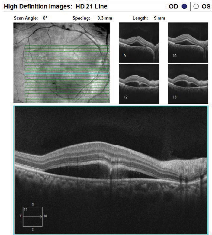 Fig. 9. This is a high-definition 21-line raster of the RPE disruption with CSCR from the same patient 