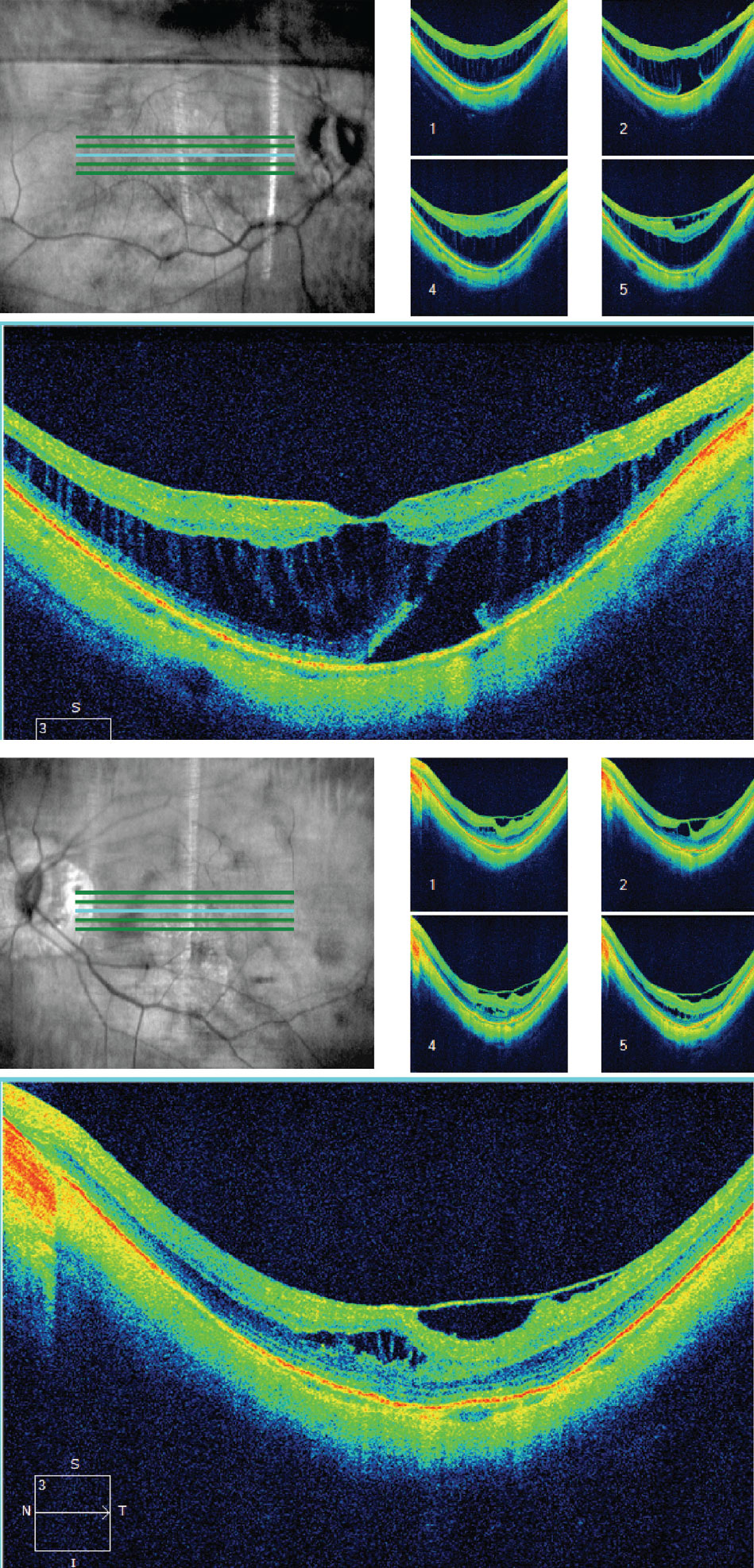 These OCT images of the right (at top) and left eye on initial presentation. Note the obvious changes in both maculae. 