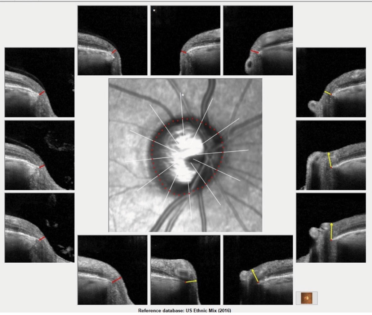 Bruch’s membrane opening overview image of the patient’s right eye. Note the thinned neuroretinal rim OD from 6 o’clock to 12 o’clock, consistent with moderately advanced glaucoma.