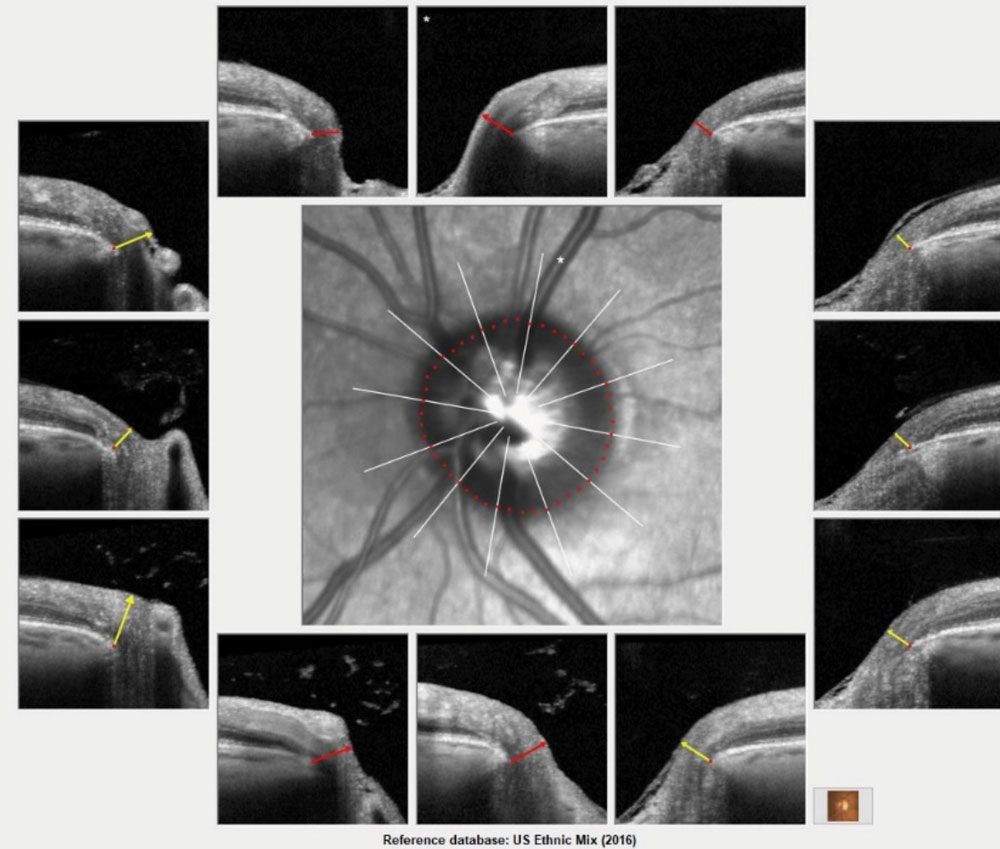 Bruch’s membrane opening overview of the patient’s left eye demonstrating moderate glaucomatous optic neuropathy.