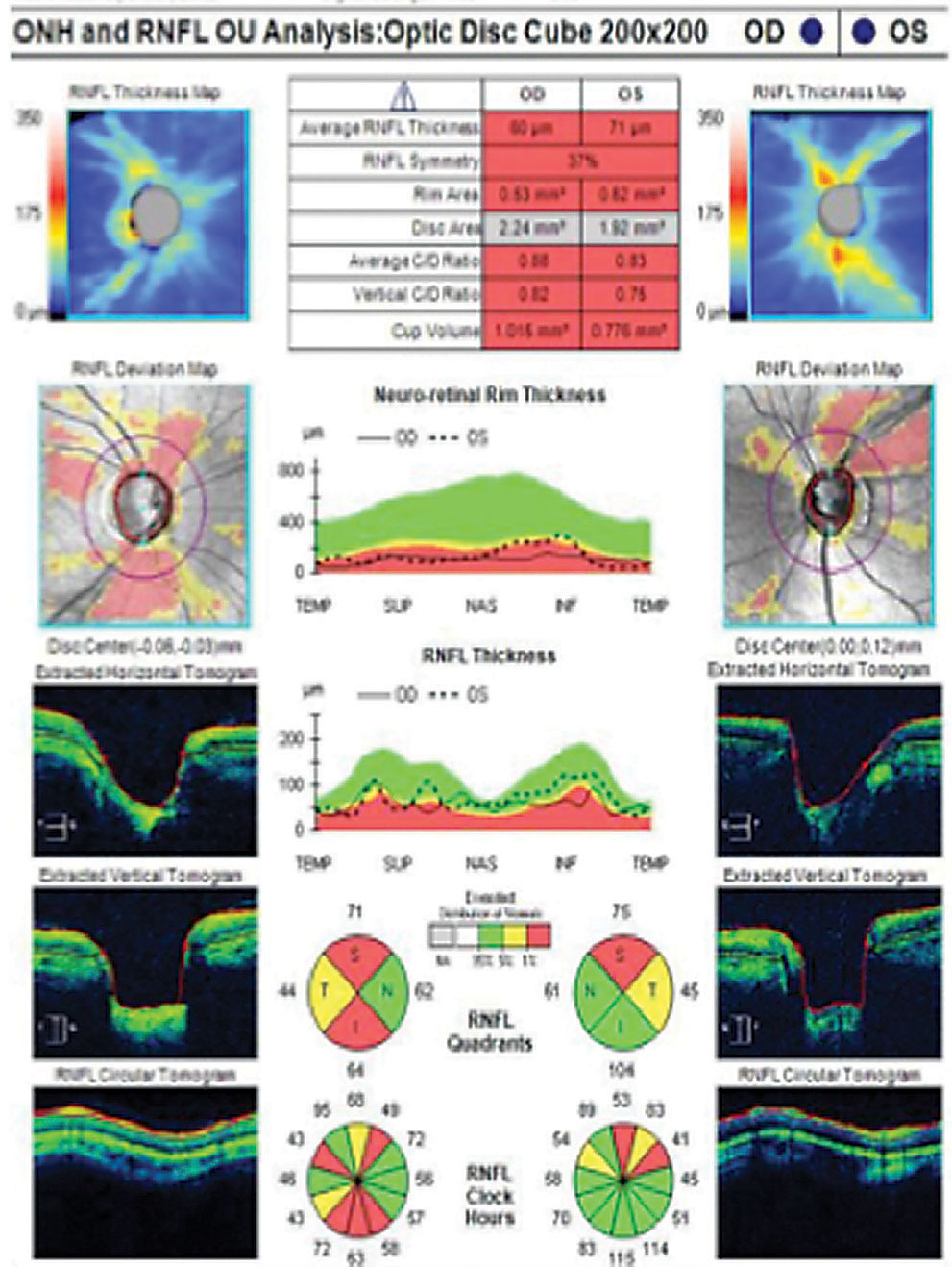 OCT imaging shows advanced thinning on the thickness and deviation maps, which correlates with the circular RNFL tomogram.