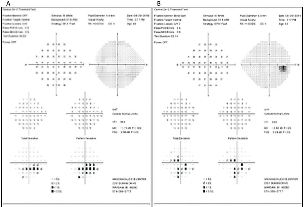 The patient’s SAP (24-2) reveals moderate inferior arcuate to fixation OS (A) and moderate inferior arcuate to fixation and superior central and paracentral defects OD (B).