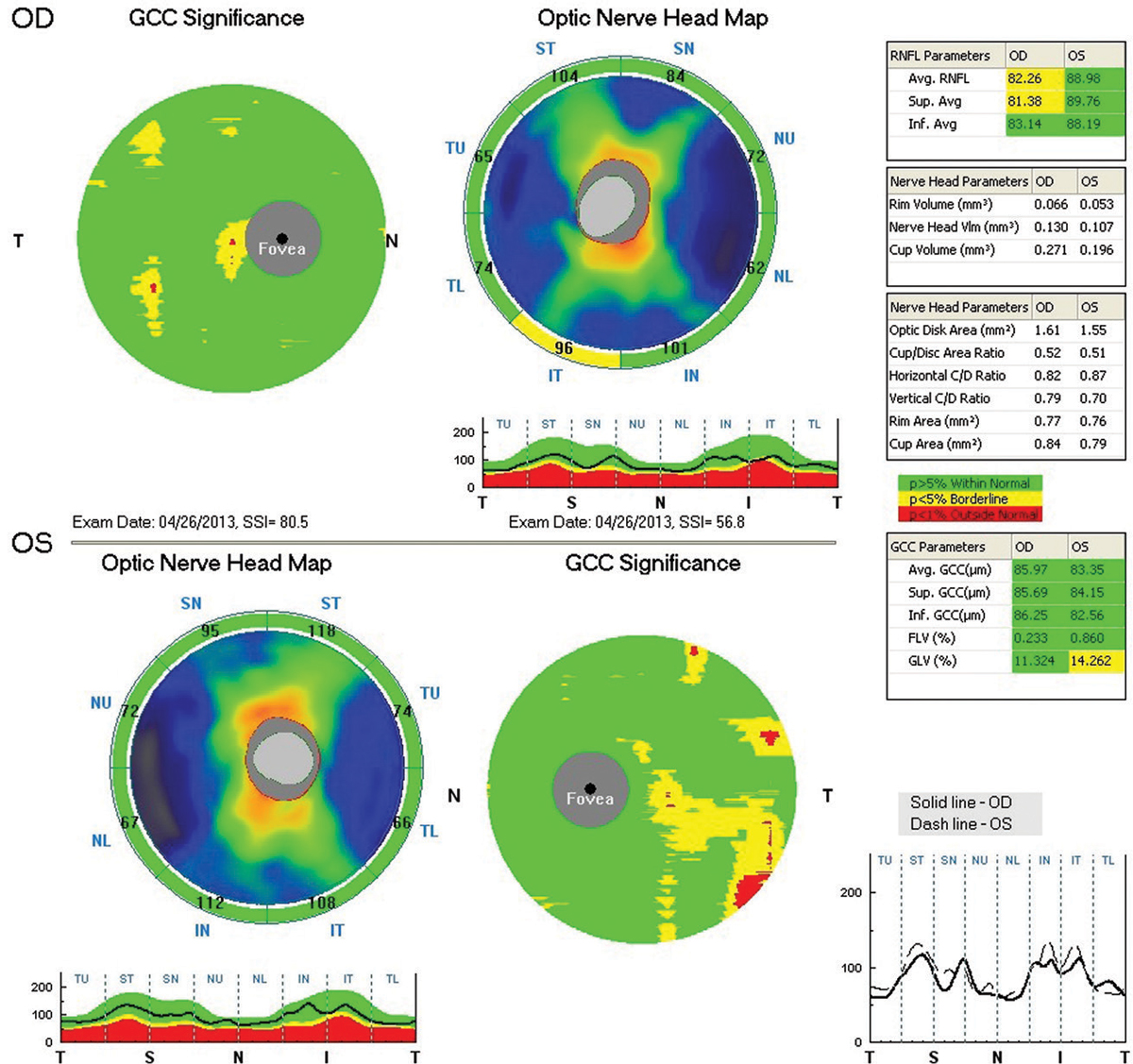 Fig. 2. RNFL and GCC OCT imaging at presentation in 2013 shows a thick RNFL OU and relatively thick GCC OU.