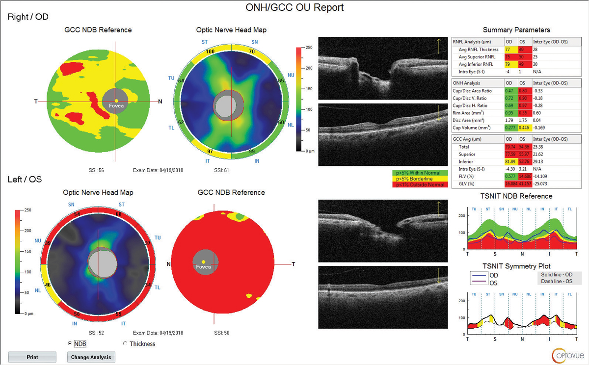 Fig. 3. RNFL and GCC OCT at follow up in 2017 shows significant RNFL and GCC thinning of the left eye.