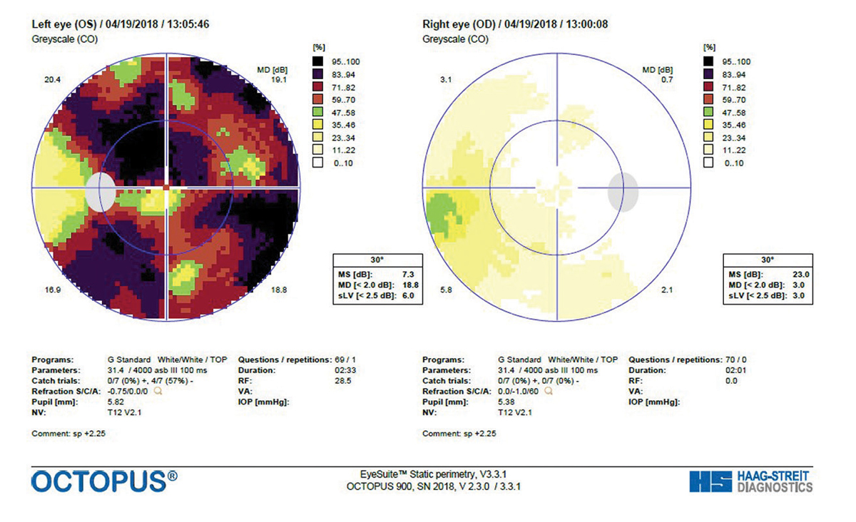 Fig. 4. A GTOP visual field completed in 2017 shows a small depression of the right eye and significant reduction of the left eye. 