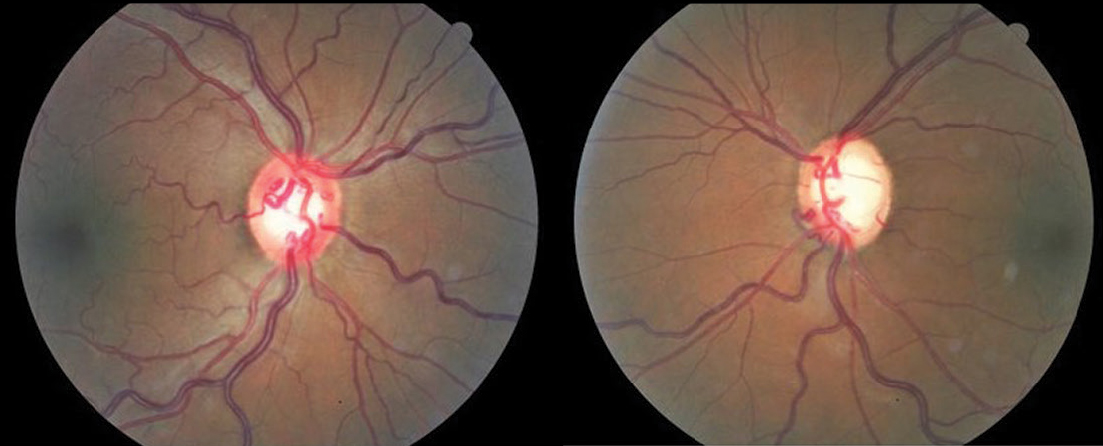 Fig. 5. Asymmetric cupping in a PG patient with hypertensive retinopathy.