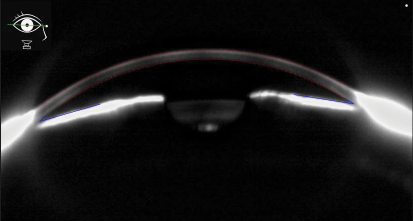 Fig. 6. This Scheimpflug anterior segment image shows narrow angles in a chronic angle closure patient. 