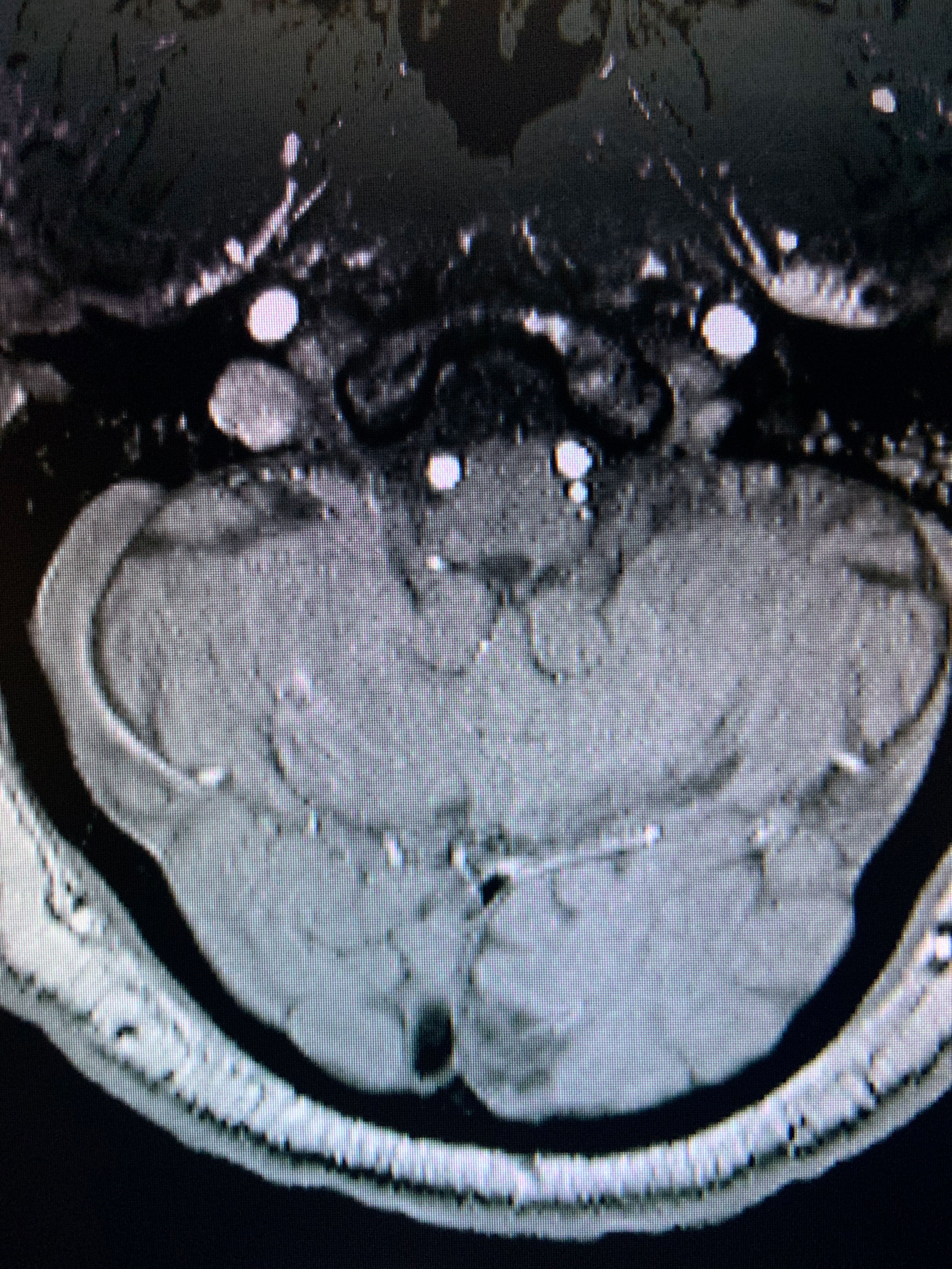 Ischemic stroke within the left occipital cortex can lead to a right hemianopia.