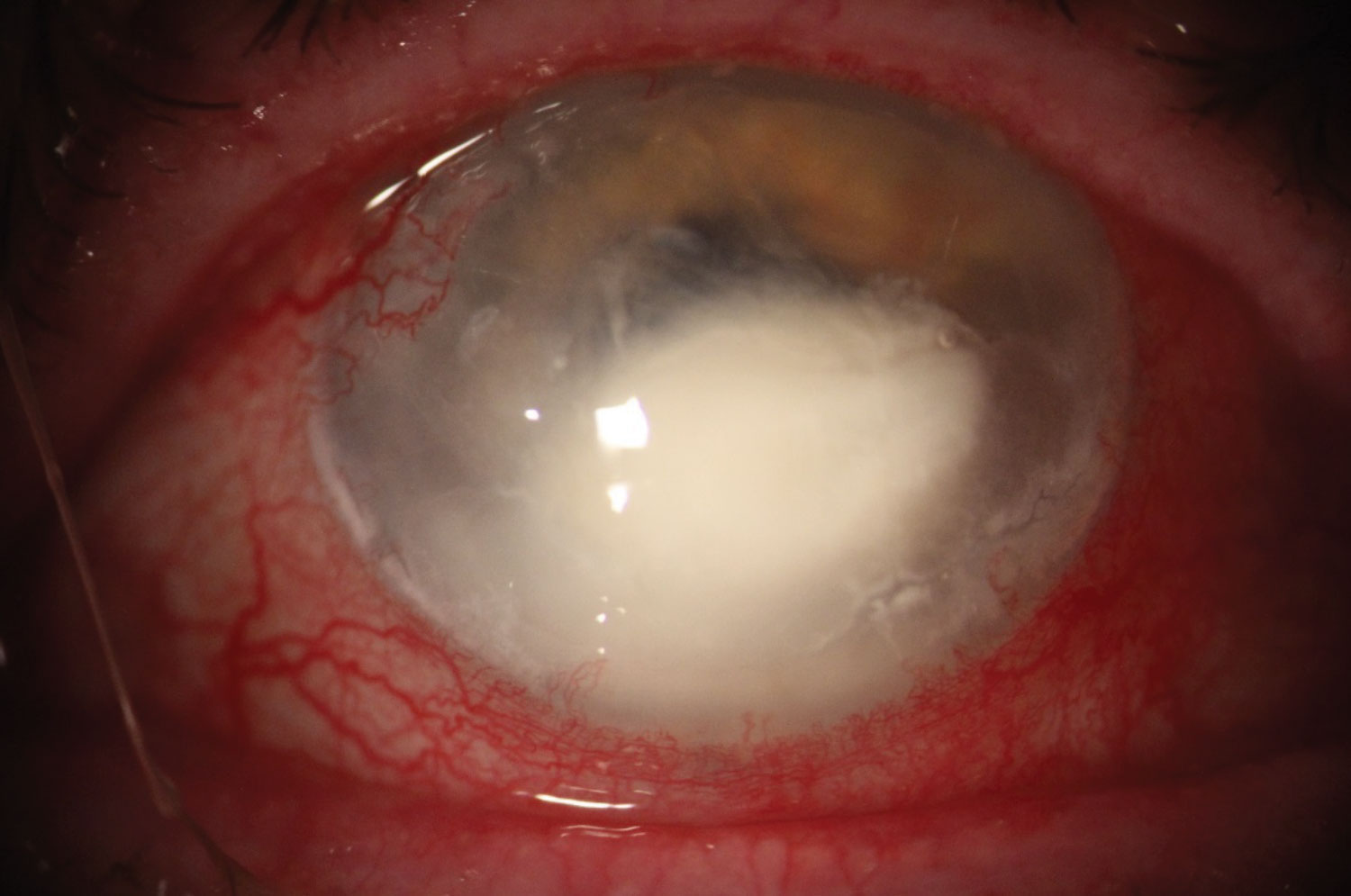 This image shows a bacterial ulcer caused by the gram-negative rod Serratia marcescens.