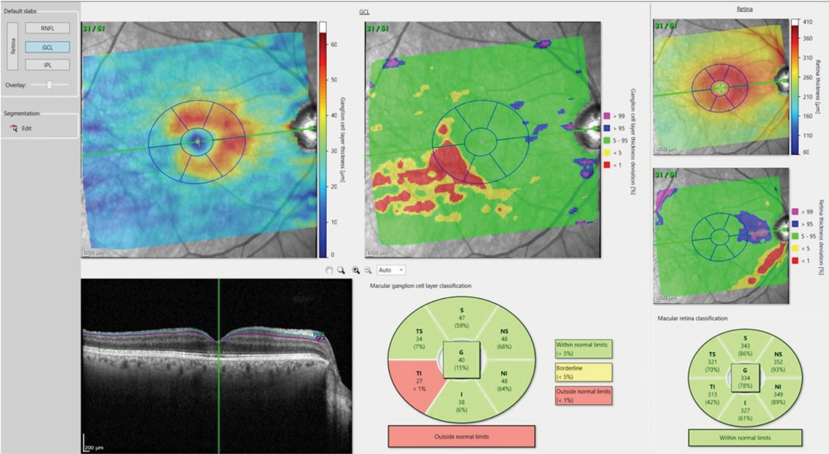 Figs. 4a and 4b. The deviation map in 4a (above) highlights an area in the temporal, inferior macula of loss of ganglion cell bodies, which matches up nicely with figure 4b (below), which shows the comparable damaged RNFL axons in the same eye.