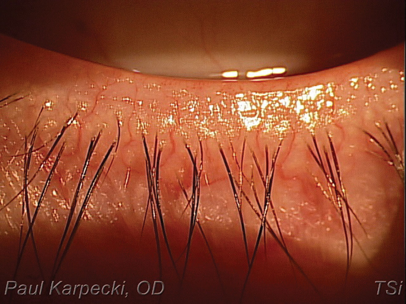 Patients with hyperemia and telangiectatic vessels are ideal IPL candidates.