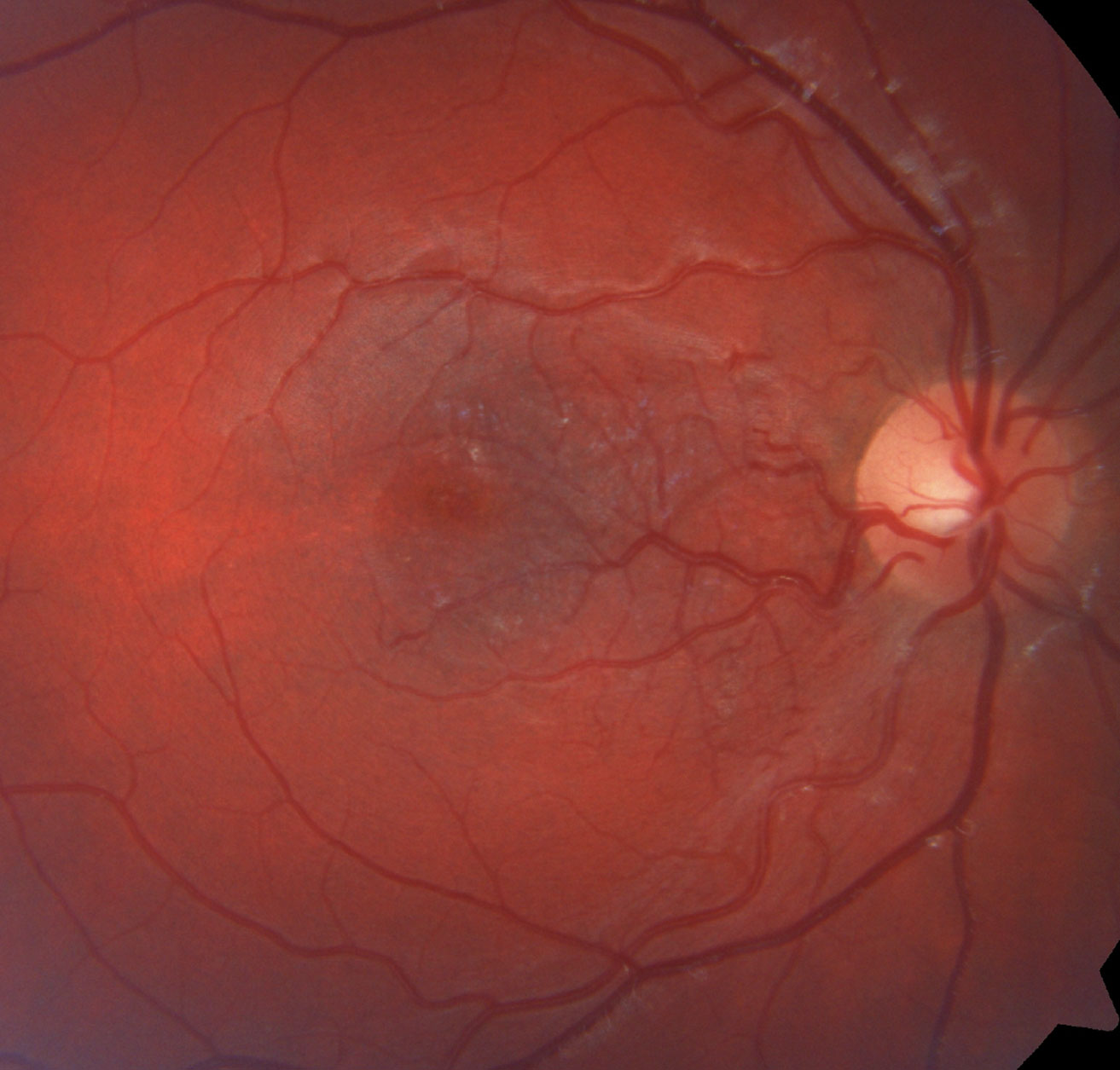 Can you identify the patient’s condition based off this image?