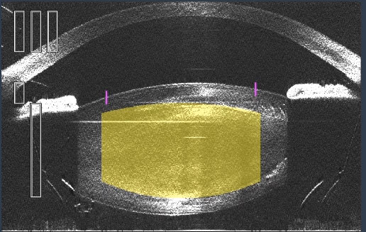 This OCT image shows the lens during a femtosecond laser cataract procedure.