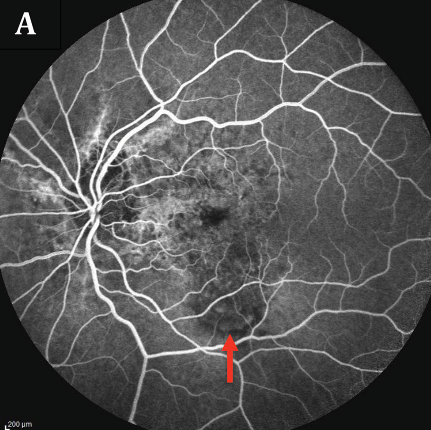 Fig. 3. The patient’s fluorescein angiography of the left eye (A) shows early hyperfluorescence noted inferior to fovea with late leakage (B). Angioid streaks surrounding the nerve can also be seen as staining. 