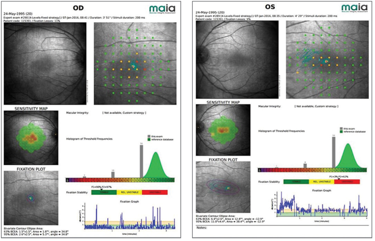 Fig. 3. Microperimetry of a 20-year-old patient with partial achromatopsia reveals small central scotomas that affect his vision.