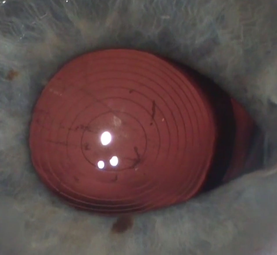 The Symfony IOL uses refractive echelettes that appear similar to the concentric rings of a multifocal but diffract rather than split the light entering the eye.