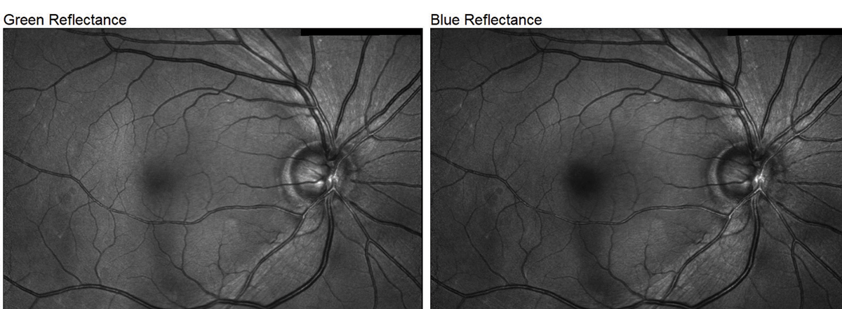 Fig. 2. The Spectralis’s multicolor imaging mode demonstrates the S/T defect in our glaucoma patient. It can sometimes be difficult to appreciate NFL defects in fundus photos, especially for early-stage patients such as this one, but the above example highlights it exceptionally well.