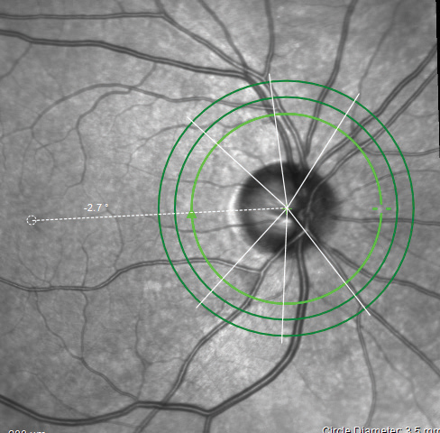 The ONH/RNFL scan indicating the Anatomic Positioning System on the Spectralis.