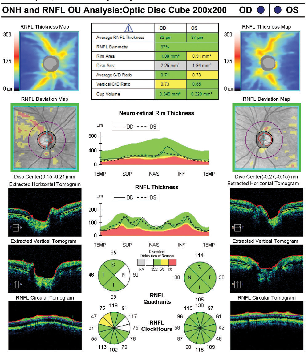 Fig. 12. This summary report from the Zeiss Cirrus 6000 retains the simplicity and familiarity of the company’s long history in OCT applications for glaucoma. This report also flags the ONH disc area (gray line in the table) as outside normal parameters, which suggests a need for caution as this may be an anatomically larger disc. 