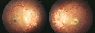 Papilledema may be seen in patients who have sleep apnea.