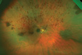 This patient has a history of hairy cell leukemia and has had leukemic retinopathy for a number of years. He later developed a hemi-retinal vein occlusion in the right eye.