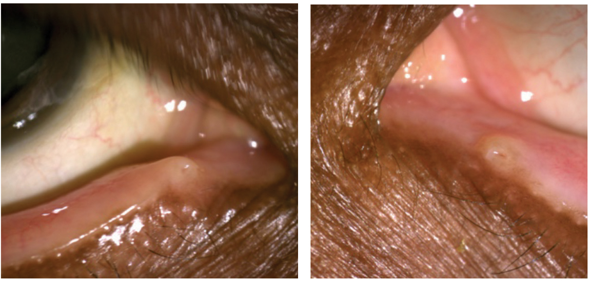 This patient displays punctal stenosis in both eyes. 