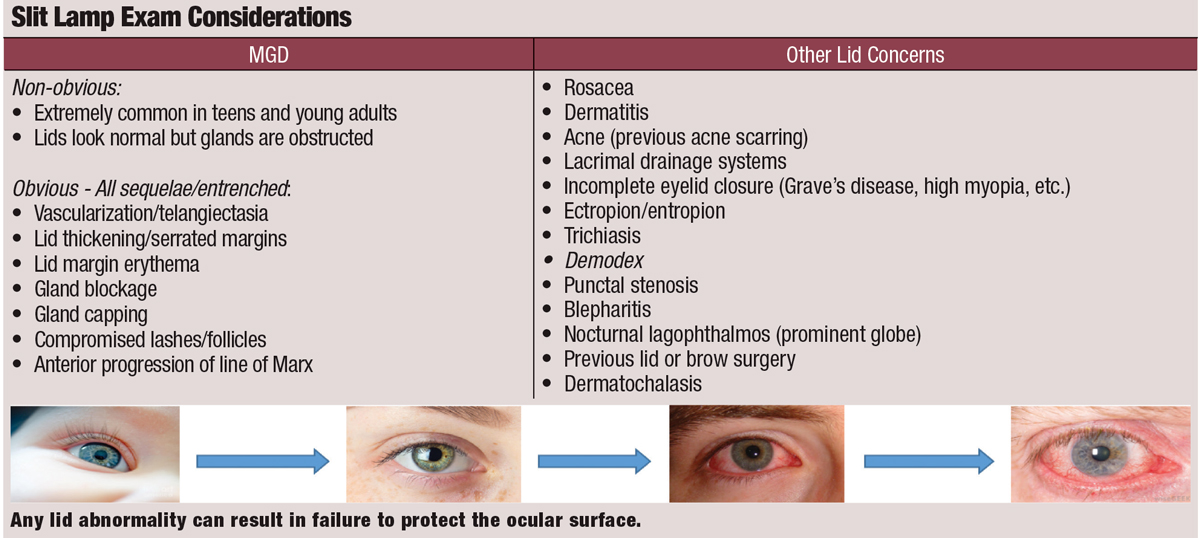 Slit Lamp Exam Considerations