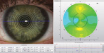 Topography over a scleral lens shows 1.7D of lens flexure.