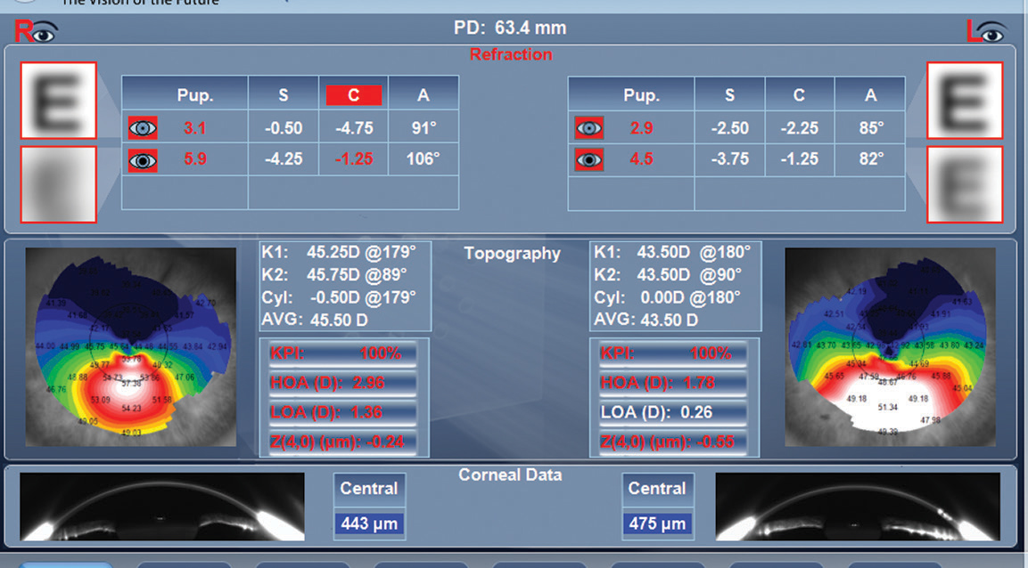 This Luneau VX120 image shows the topography of an eye with keratoconus.